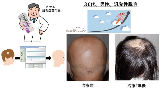 円形脱毛症　病院